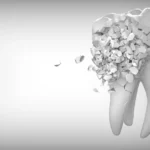 How Much To Fix A Chipped Tooth With Insurance Payzenic